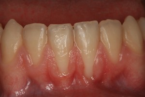 Foto con encías inflamadas | Dentista | Endodoncia | Implantes dentales