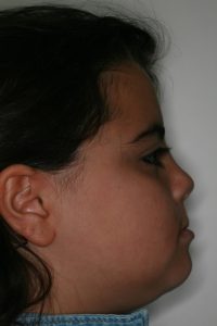 Foto del lateral moflete | Carillas dientes | Estética dental | Dentista Arganzuela