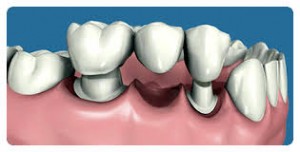 como reponer un diente perdido | Clínica dental Larrañaga | Mejores implantes dentales | Dentista implantes