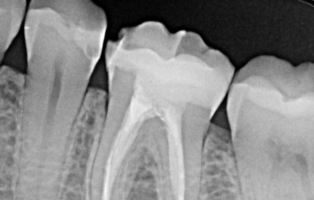 endodoncia