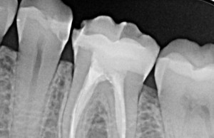 Radiografía dental | Clínica dental | Carillas | ortodoncia invisible | Larrañaga