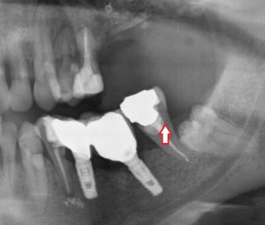 radiografía dental | Clínicas dentales | Clínicas odontología | Apnea del sueño tratamiento