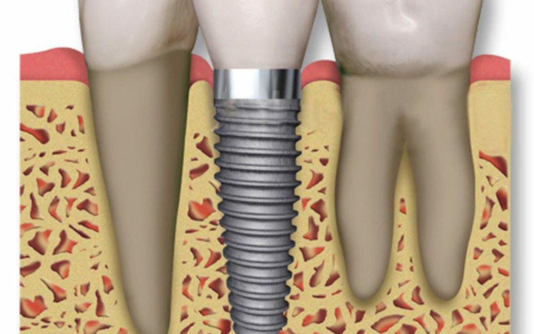 implantes de carga inmediata